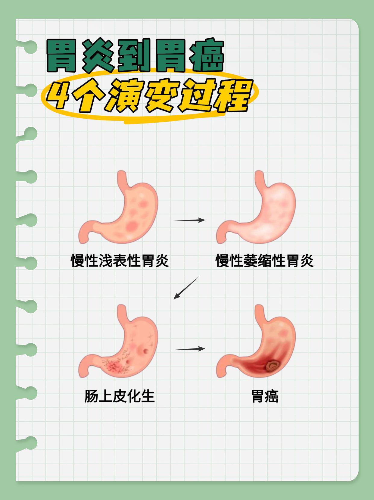 胃炎如何发展成胃癌