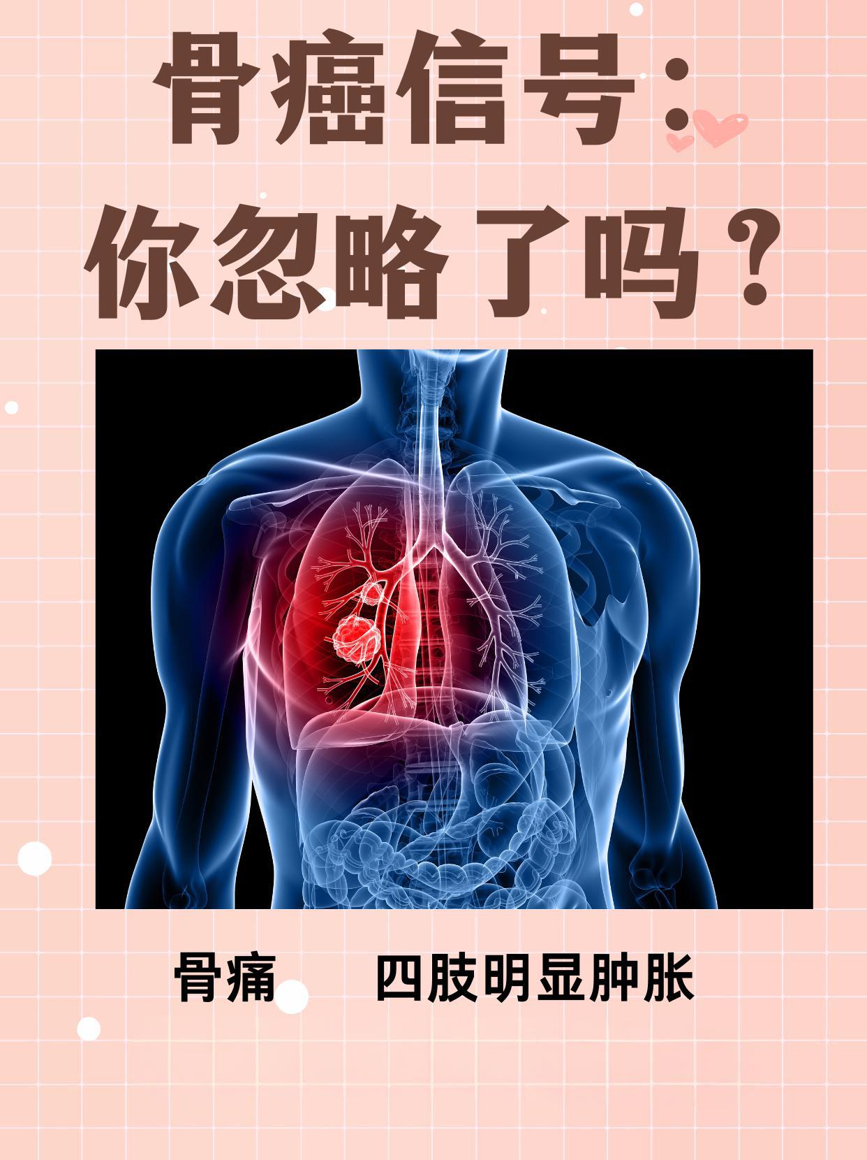 骨癌的两大信号别忽视