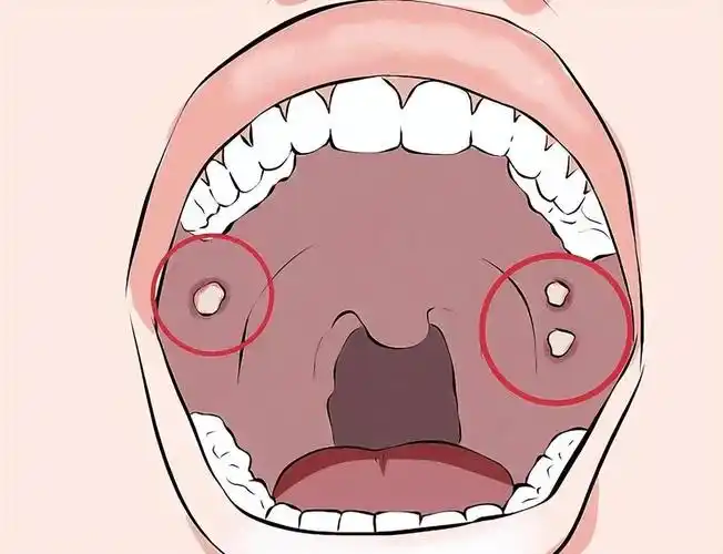 哪些生活习惯容易导致口腔癌