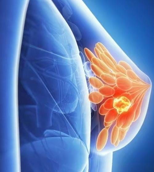 得了乳腺癌,一定要切除乳房吗