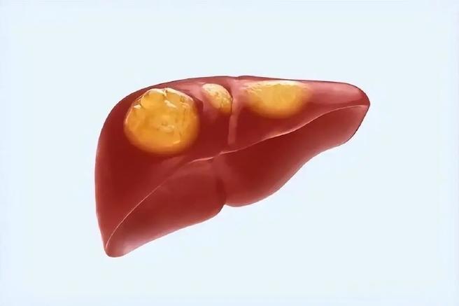 肝癌手术后多久容易复发