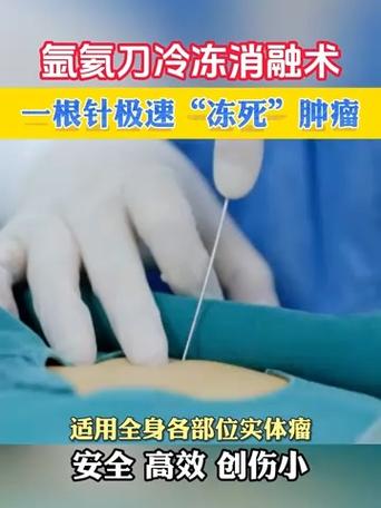 冰针冷冻消融治疗癌症