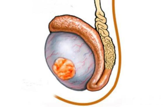 睾丸癌早期症状及表现