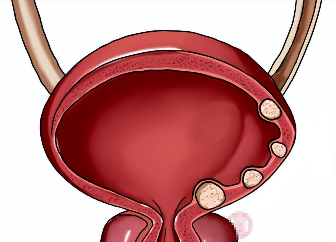 宫颈癌手术后如何预防复发?