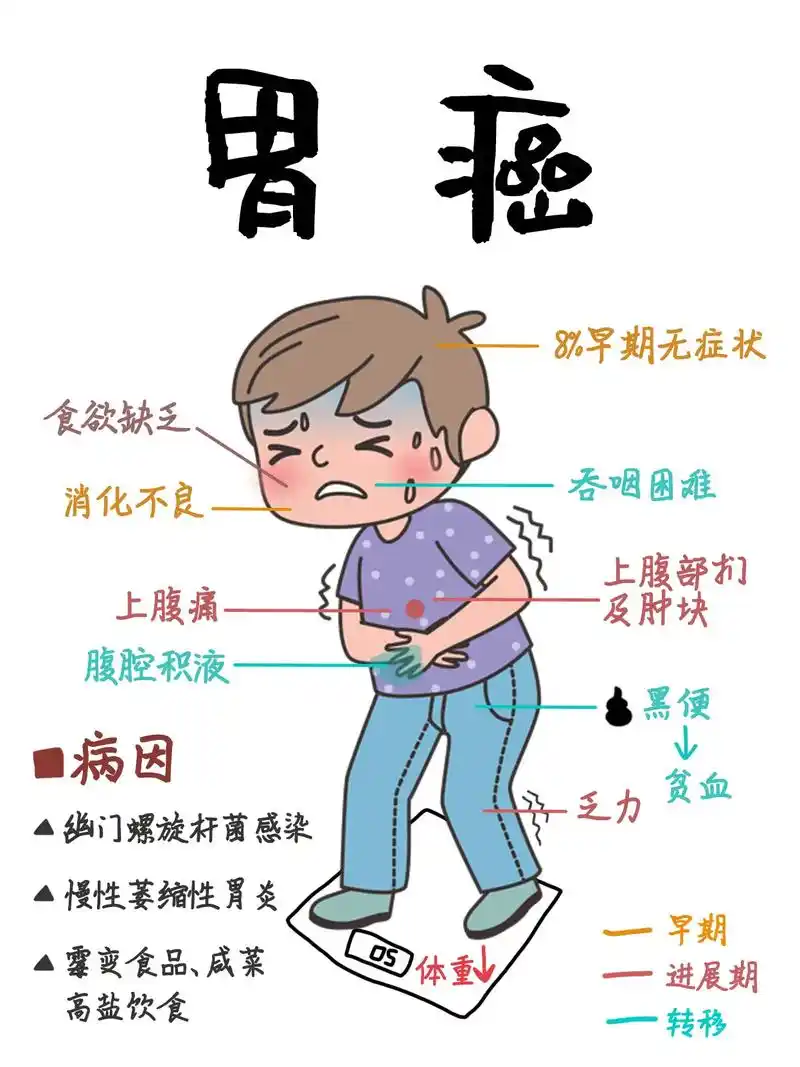 胃癌早期症状