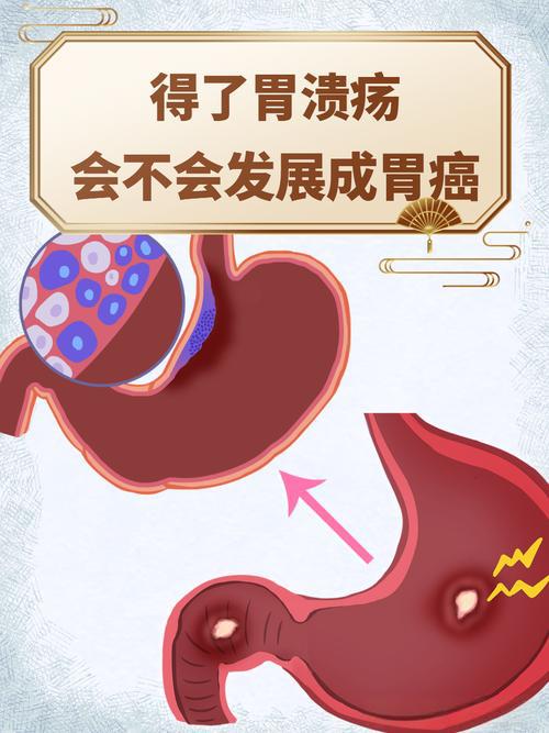 得了胃溃疡会不会发展成胃癌