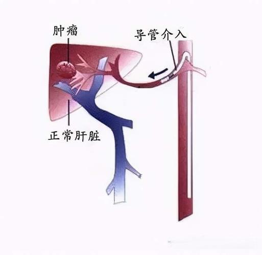 介入治疗有哪些优势？