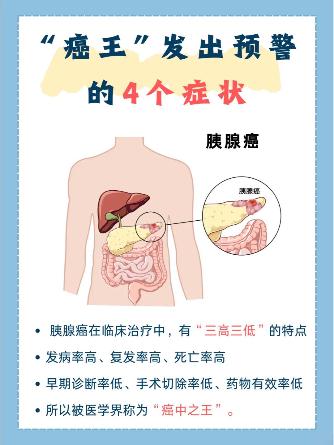 胰腺癌